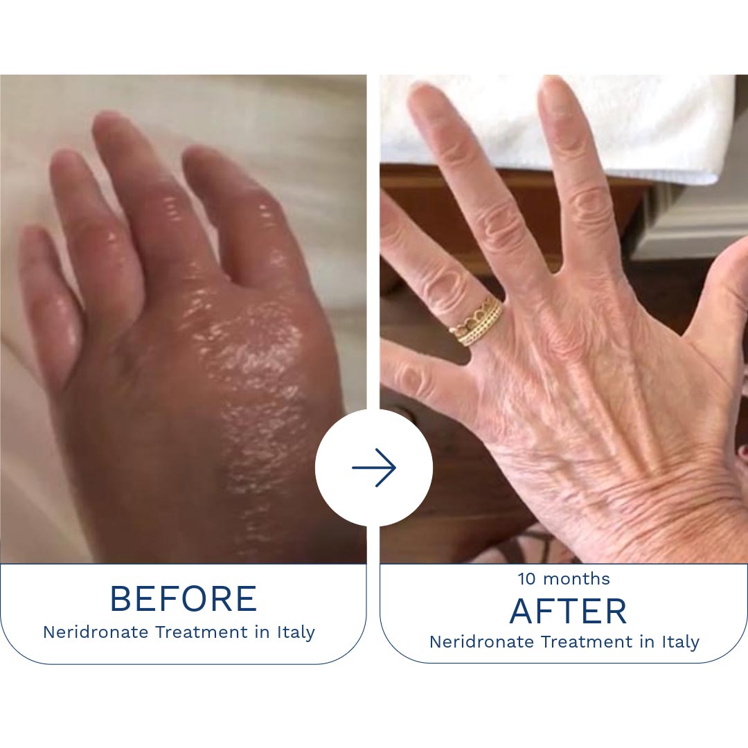 CRPS-Treatment_Carole