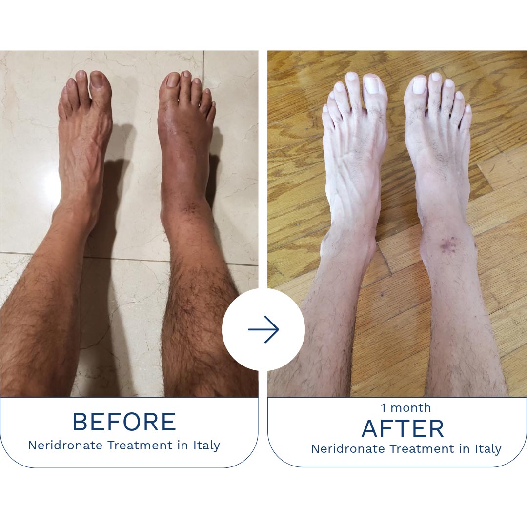 CRPS-Treatment_Fernando