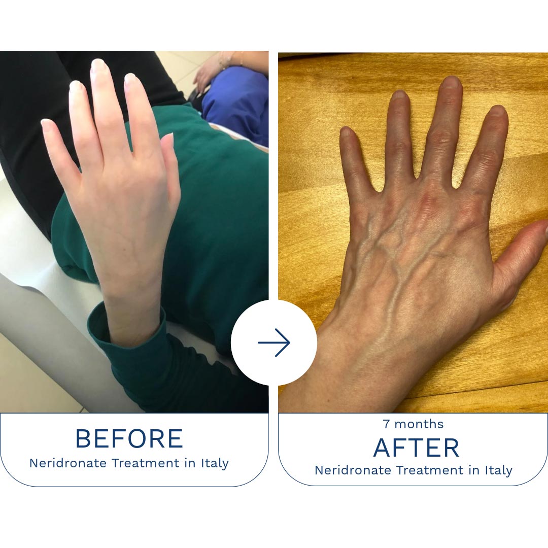 CRPS-Treatment_Patti
